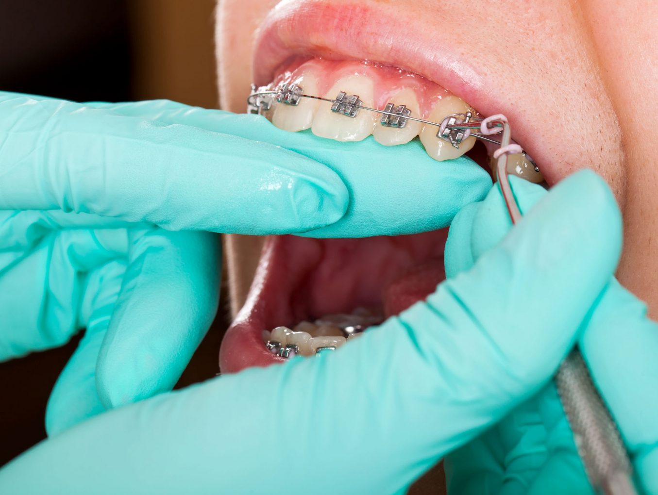 Gomas de ortodoncia, ¿para qué sirven?
